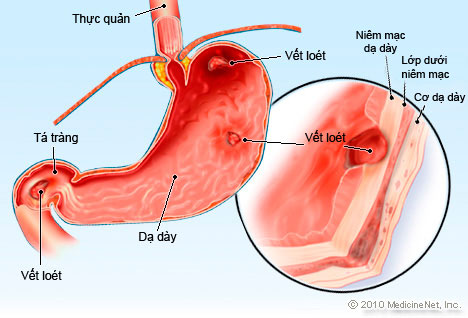 Triệu Chứng Của Đau Dạ Dày