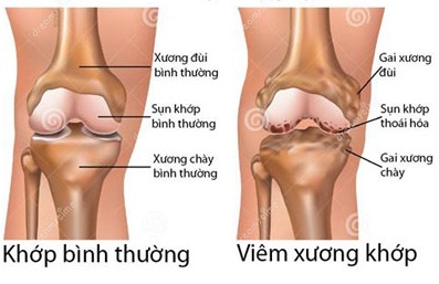 Glucosamine là gì - Công Dụng Của Glucosamine